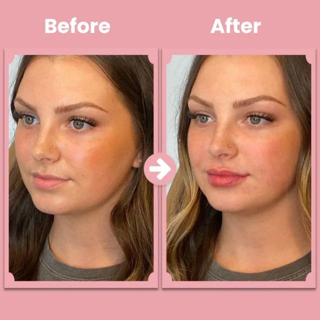 Alurain Lip Roller – Natural full lips that shine confidently, completely painless