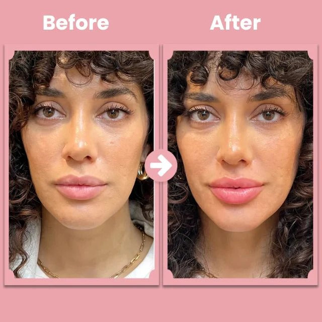 Alurain Lip Roller – Natural full lips that shine confidently, completely painless