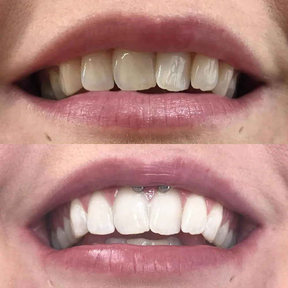 1+1 FREE | Diamond Smile™ Smile Brighter, Feel Stronger and More Confident